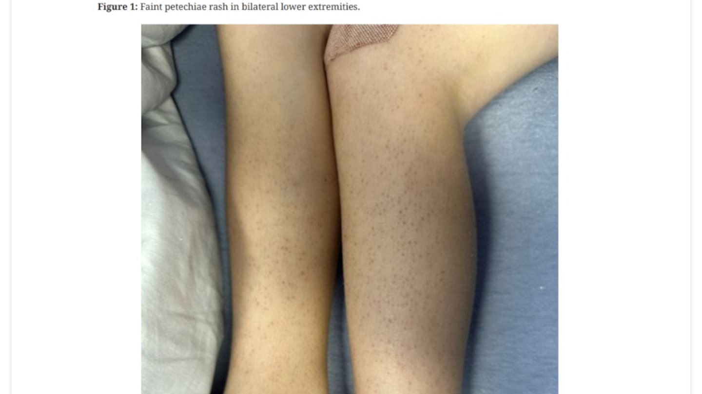 Boy, 5, diagnosed with scurvy after diet of chicken and biscuits