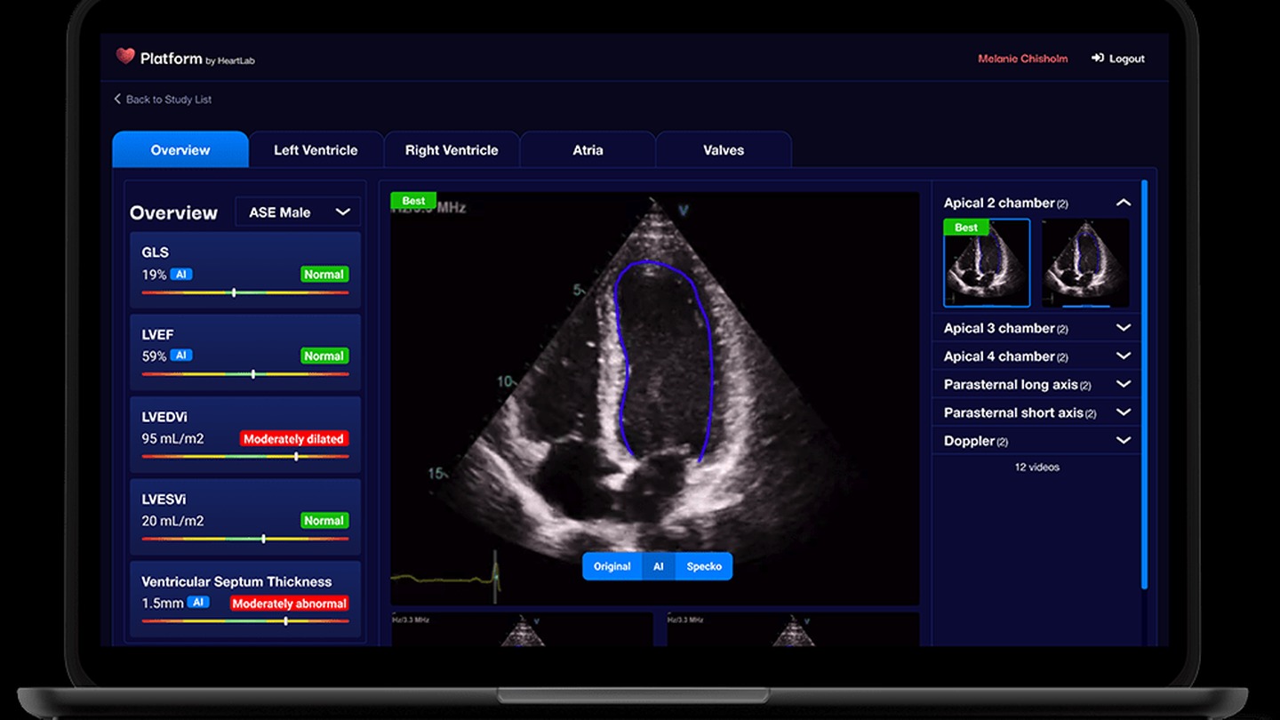 An echocardiogram ultrasound is a non-invasive test that can show blockages and other damage.