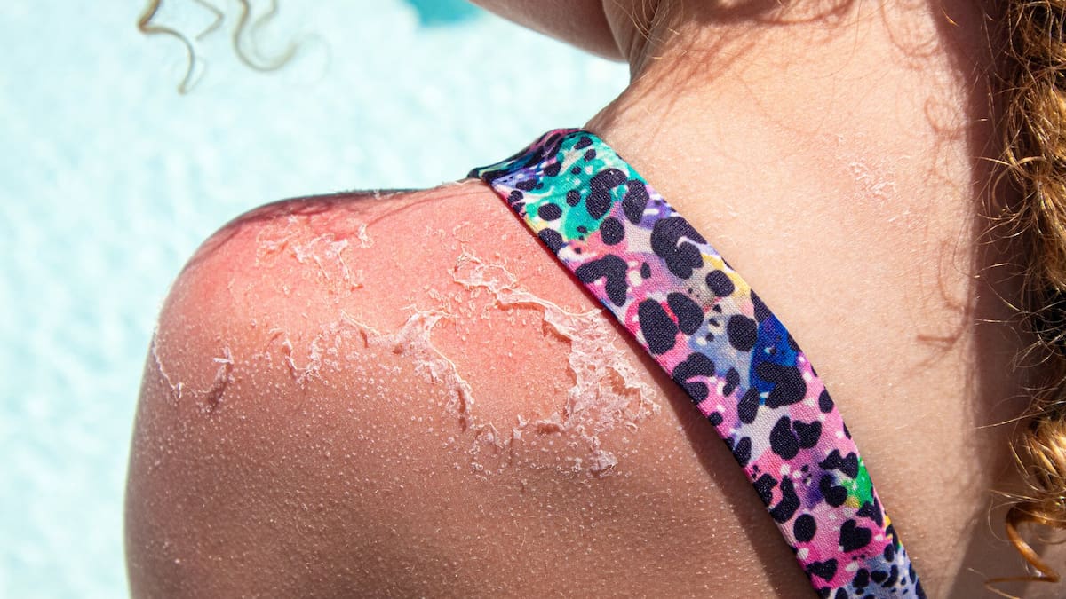 Skin cancer drug expansion proposal being considered