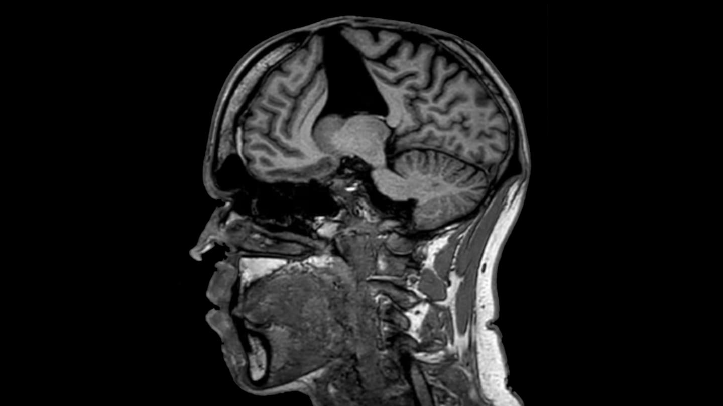 Kiwi man gets incurable brain disease after given graft from dead body as a baby