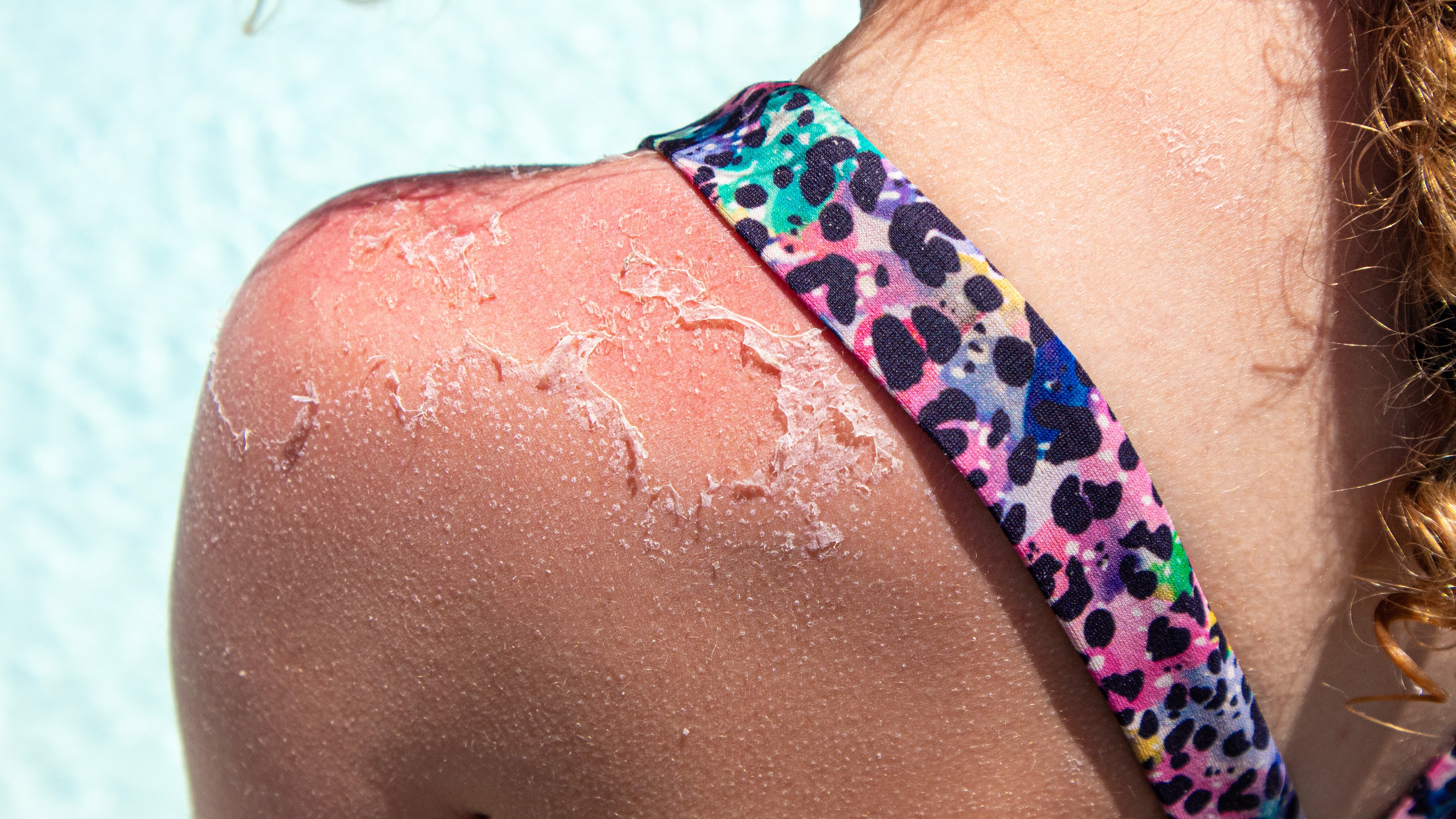 "Really concerning": New sunburn data raises concerns over skin cancer 