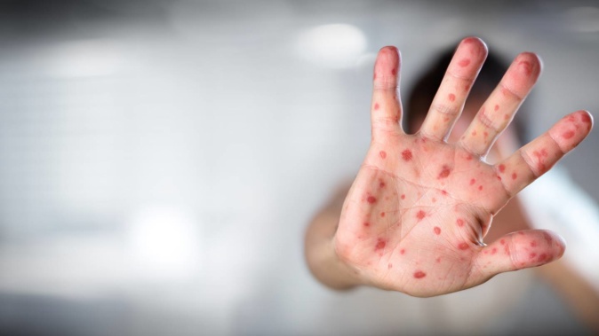 For the first time since the 2019 outbreak, a measles case has been confirmed in New Zealand. Photo / Supplied