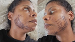 Shirley Agostinha de Oliveira was burnt after she received a facial treatment. Photo / Supplied