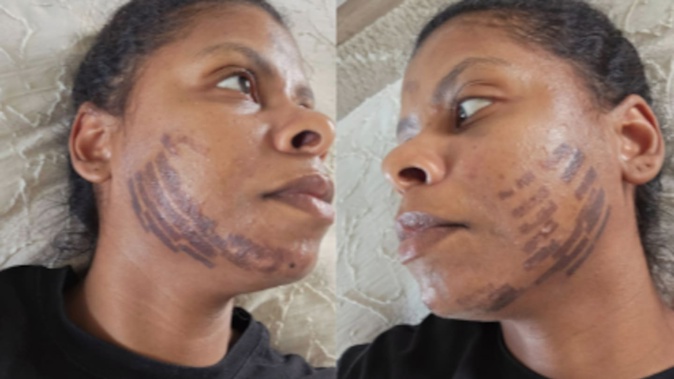 Shirley Agostinha de Oliveira was burnt after she received a facial treatment. Photo / Supplied