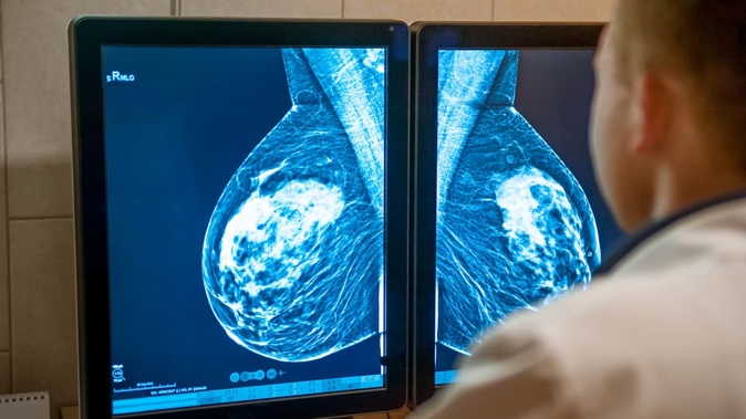 Multiple women across New Zealand have had their breast implants burst during routine mammograms. Photo / 123RF
