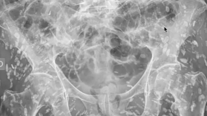 A doctor was left stunned after an X-ray revealed a man infested with hundreds of tapeworm eggs.