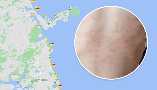 Auckland beachgoers are reporting symptoms similar to chicken pox due to sea lice in the water at popular bays.
