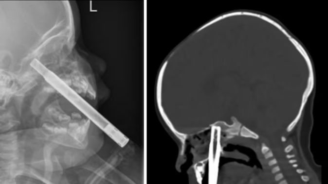 An X-ray of the child's head after they were impaled with a straw. Photo / NZMJ