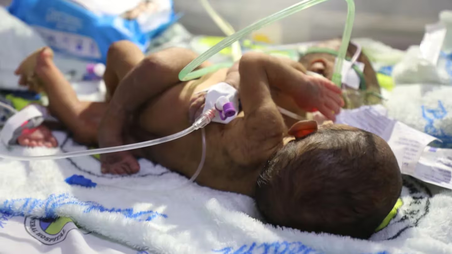 Dr Kone Sobi said it's a precarious condition for both as they depend on each other. Photo / Port Moresby General Hospital