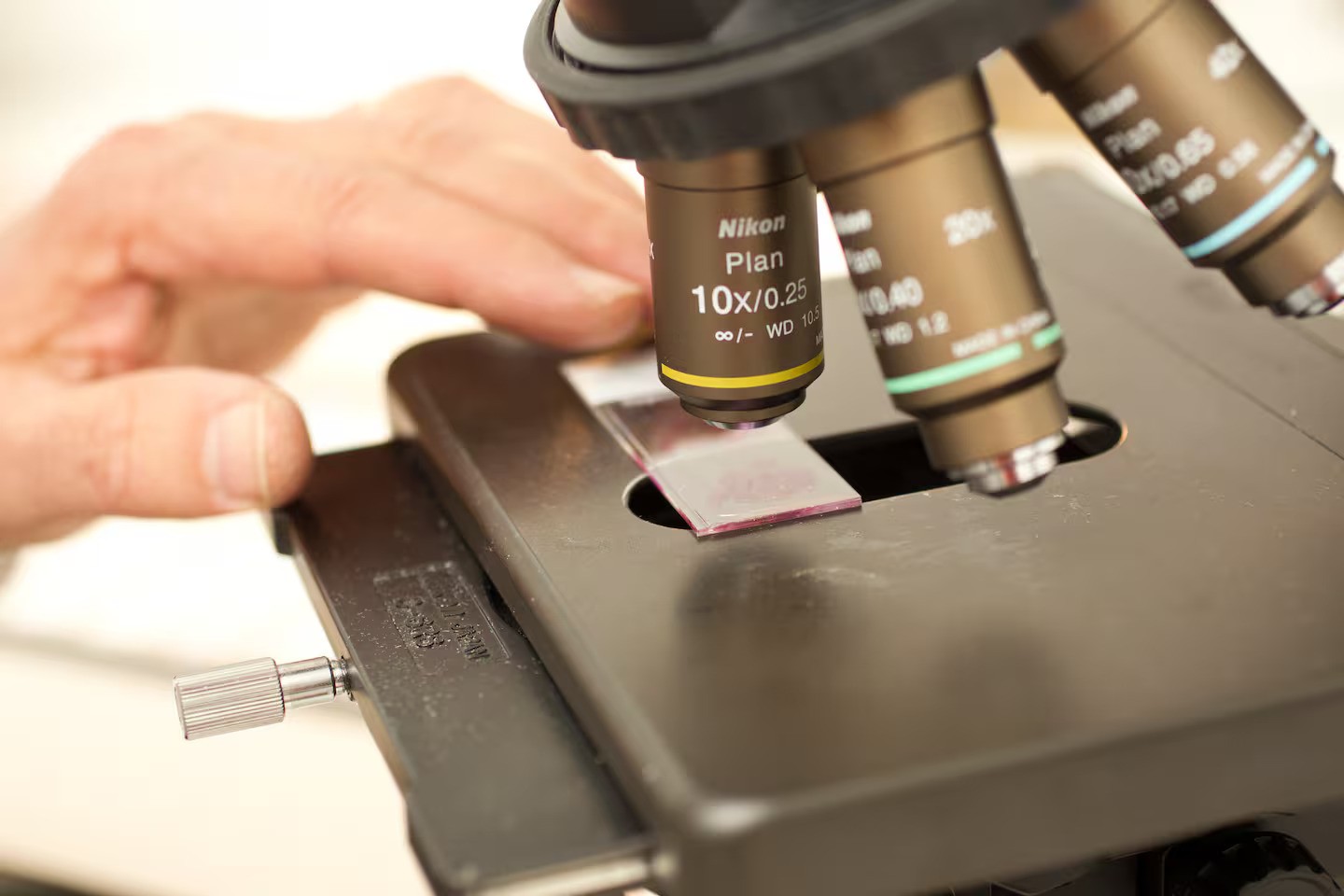 Cancer missed three times: Call for review of lab tests after woman's death