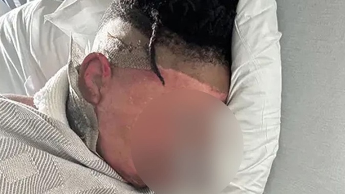 A 12-year-old boy has suffered severe burns after his friends allegedly threw boiling water on his face while he slept during a sleepover "prank".