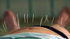 A Chinese acupuncture practitioner has been found in breach of patient rights. Photo / NZME