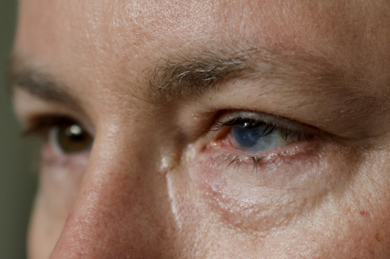 Phil Durst, who has undergone an experimental stem cell procedure with his eyes, sits for a portrait in Homewood, Ala., on Tuesday, Aug. 15, 2023. Photo / AP