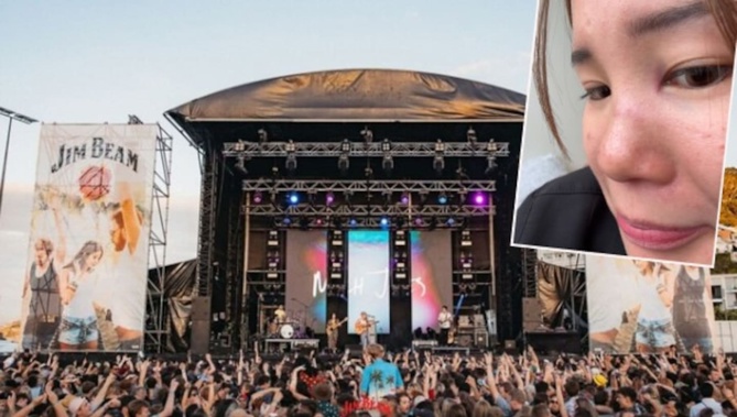 Alyssa Ta suffered a fractured nose, black eye, and possible concussion after being hit by a flying drumstick at Homegrown. Photos / Supplied / Alyssa Ta