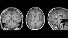 This image shows a brain scan used in an AUT-led study that revealed a telltale marker of mild traumatic brain injury. Photo / Auckland University of Technology