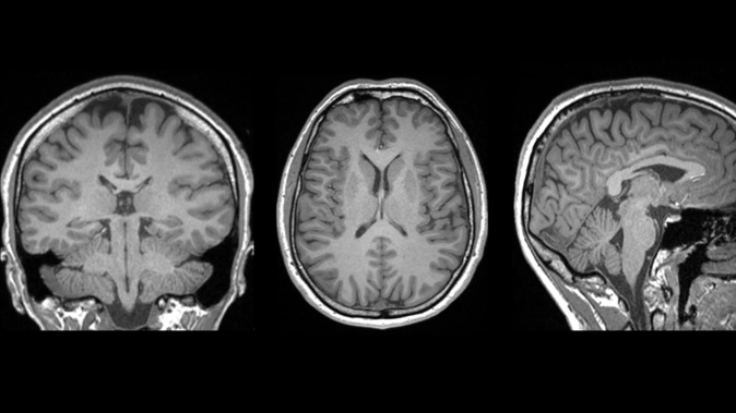 This image shows a brain scan used in an AUT-led study that revealed a telltale marker of mild traumatic brain injury. Photo / Auckland University of Technology