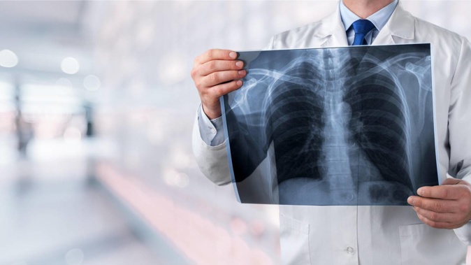 A mass on the patient's lung grew from 15mm to 45mm within three months but it could have been treated when detected on a chest X-ray at 19mm if not for a mix-up in patients by a doctor. Photo / 123rf