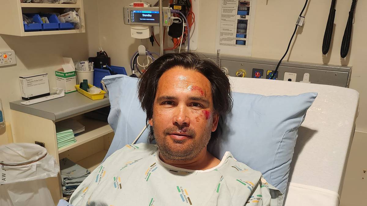 Bridges said he had broken his wrist as well as hurt his face.