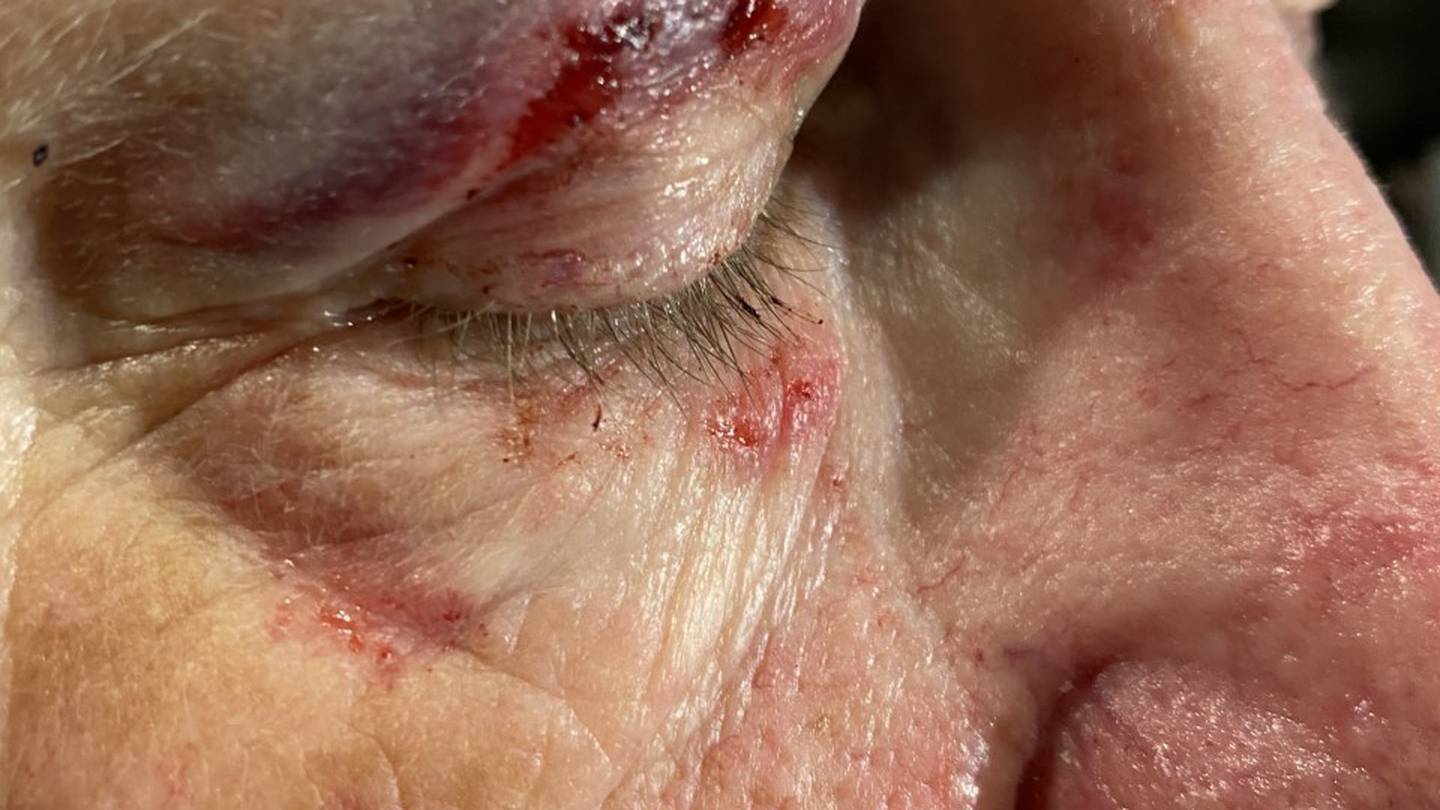 The 69-year-old was left a horrible eye injury after one of the teens attempted to stratch it out with her nails. (Photo / Gabi Wildbore)
