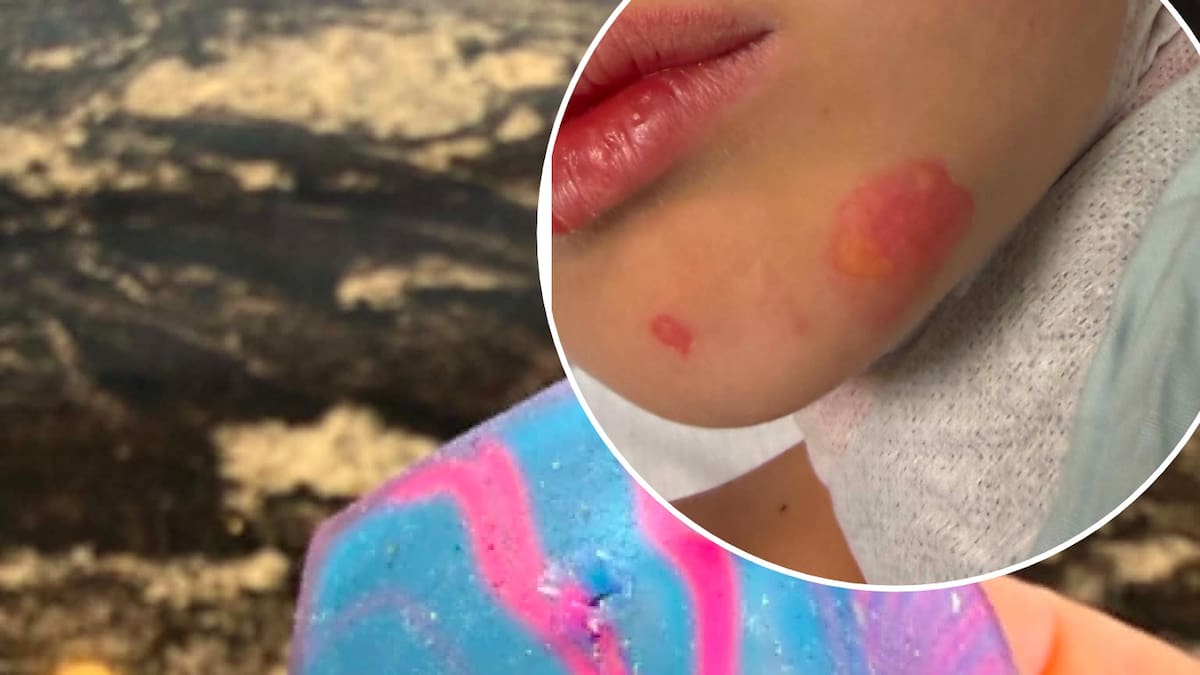 Viral squishy toy trend leaves boy with burns: Father's warning to other parents