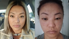Auckland woman Shena Damian says a Neutrogena skincare product left her face swollen and feeling 'burnt'. Photos / Supplied