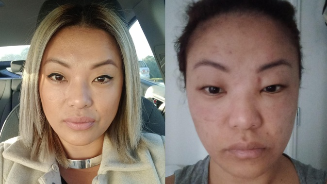 Auckland woman Shena Damian says a Neutrogena skincare product left her face swollen and feeling 'burnt'. Photos / Supplied