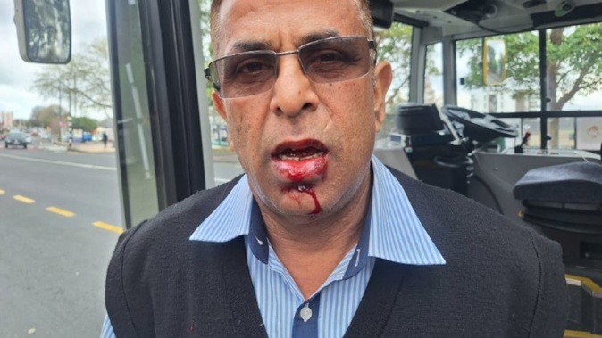 Auckland bus driver Rajnish "Raj" Trehan suffered facial injuries after he was attacked by a passenger following racial abuse at about 10am on Saturday on the Number 18 bus in Avondale near Great North Rd.