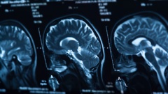 A man died shortly after a large area of bleeding on the right side of his brain was discovered. Photo / 123rf
