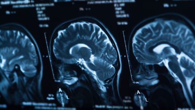 A man died shortly after a large area of bleeding on the right side of his brain was discovered. Photo / 123rf