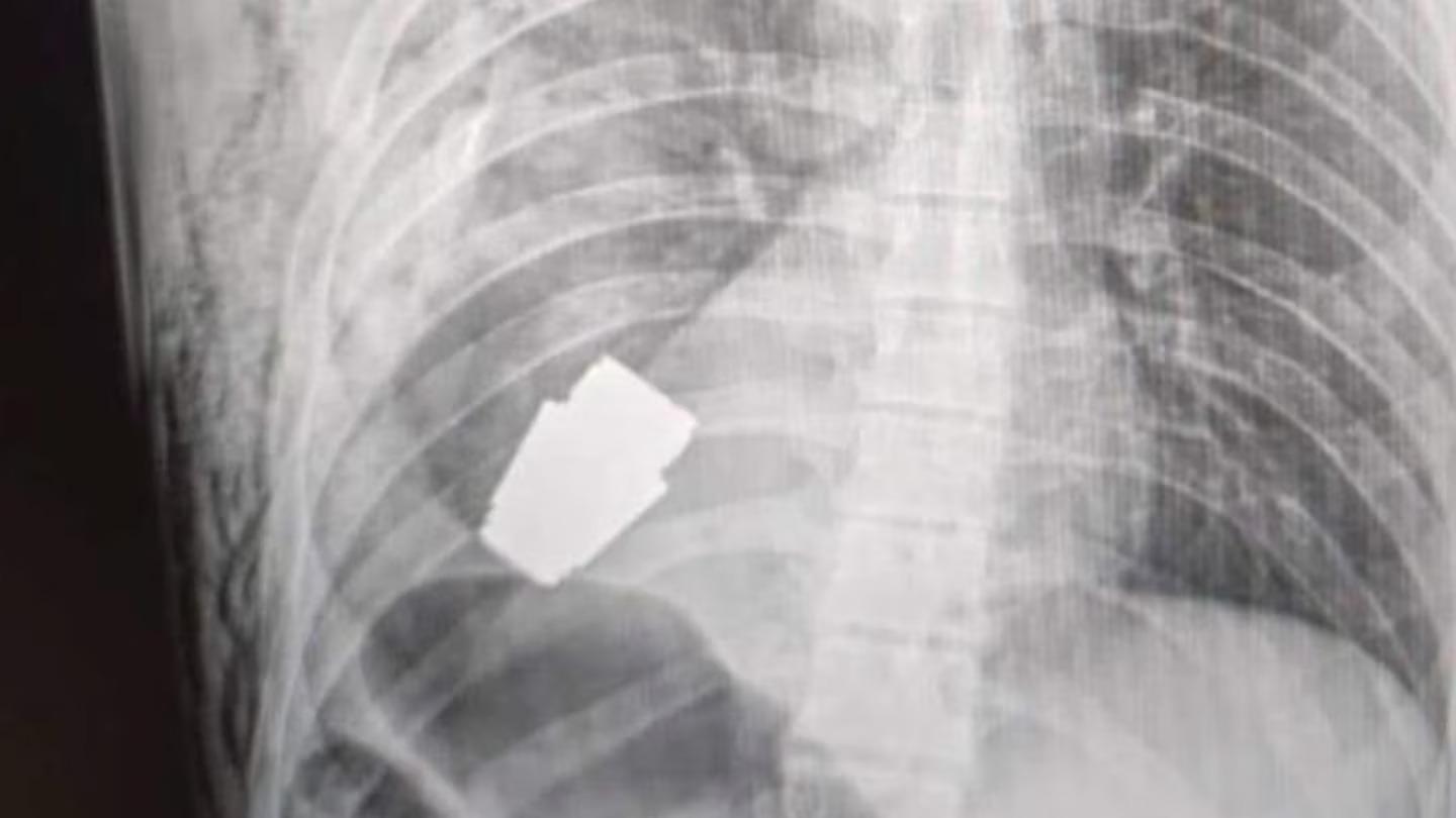 Incredible images have emerged from the conflict in Ukraine of the moment one of its most revered surgeons removed a grenade lodged in a soldier's chest. Photo / via Facebook