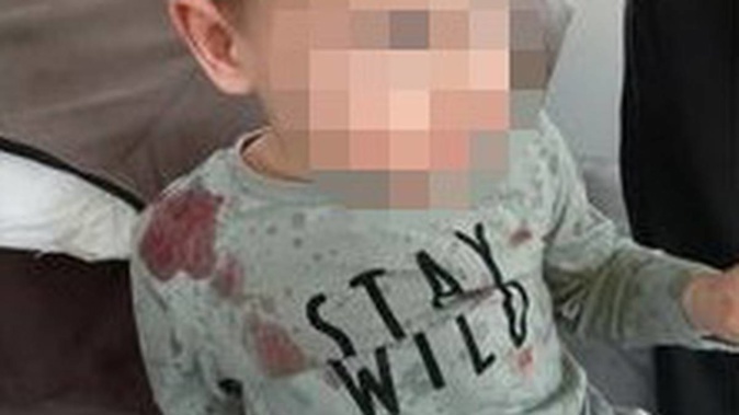 The toddler covered in blood following the May attack. His attacker has offered the victim $250. Photo / Supplied