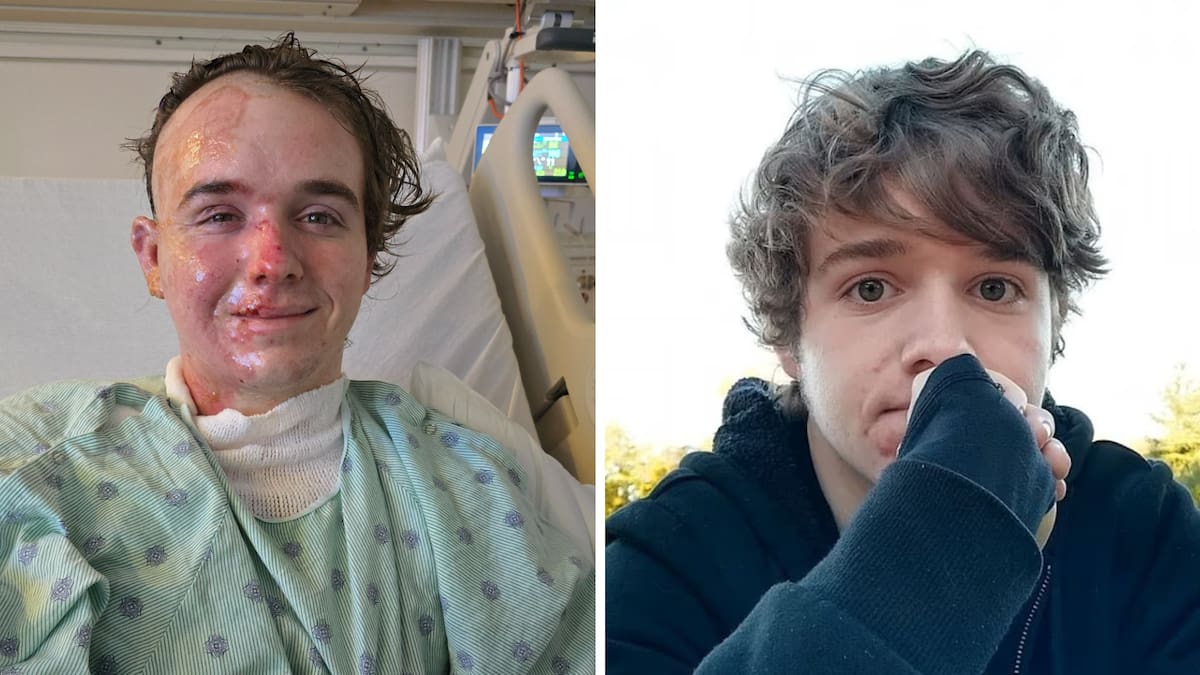 McDonald’s worker suffers severe burns after co-worker allegedly throws hot oil