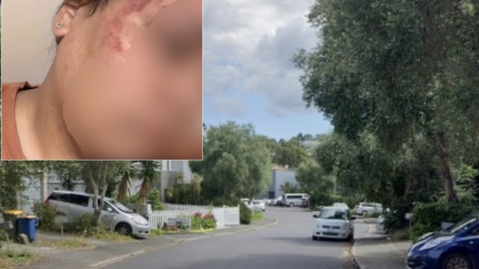 A woman says she suffered head injuries after being kicked and stomped on by a group of people living on her street in West Auckland's Glen Eden. Photos / Google / Supplied