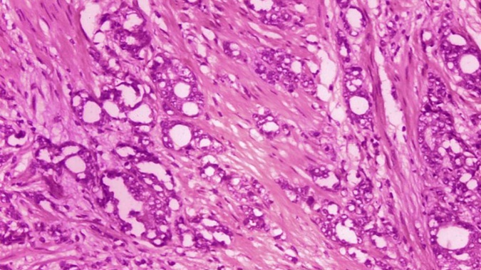 This 1974 microscope image made available by the Centers for Disease Control and Prevention shows changes in cells indicative of adenocarcinoma of the prostate. Photo / AP