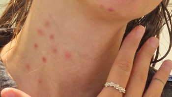 'Covered with bites': Auckland hostel issued cleansing order for bedbugs