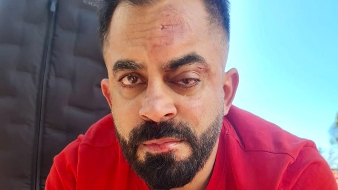 Manik Kumar suffered three fractures to his face, near his left eye socket after an attack at the Royal Oak Mall car park.