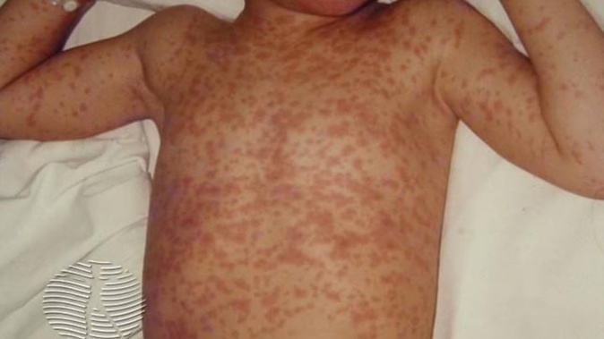Health authorities have set up a pop-up testing centre to check people’s immunity to measles and are telling close contacts at an Auckland school to isolate if they aren’t immune. Photo / DermNetNZ.org