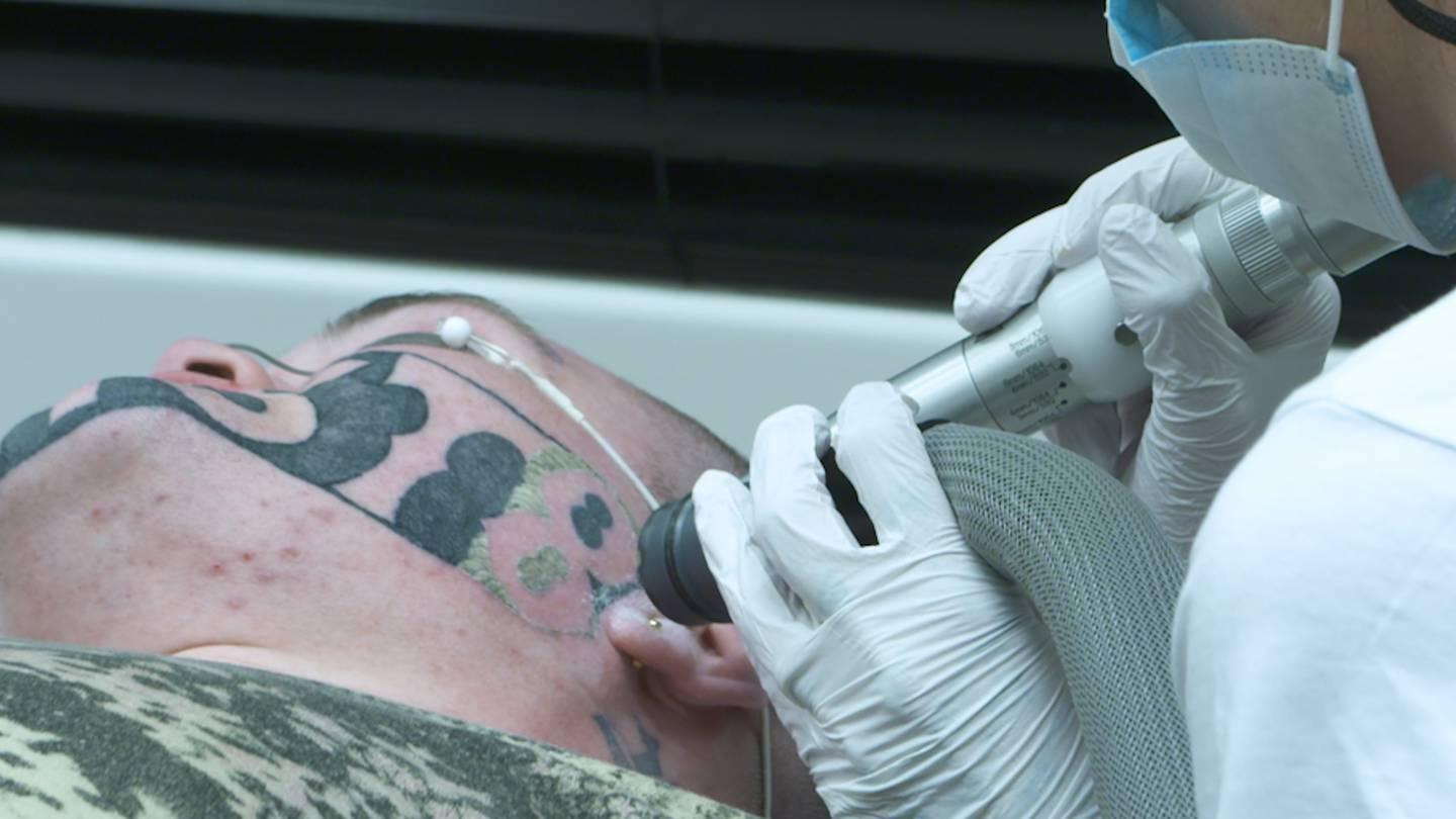 Tattoo Removal in Christchurch | Yellow® NZ