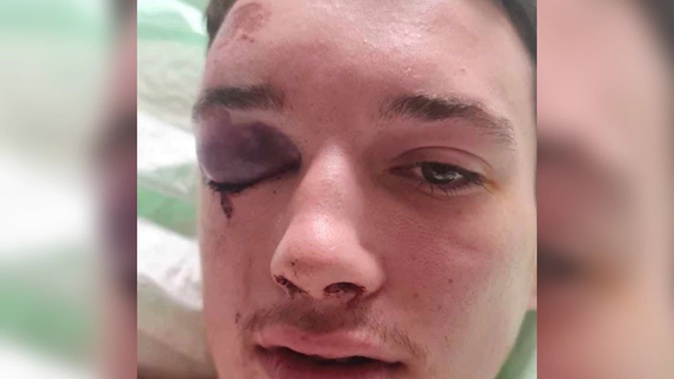 Aaron Gray said he has a hematoma on his head, three fractures and a swollen black eye. Photo / Supplied