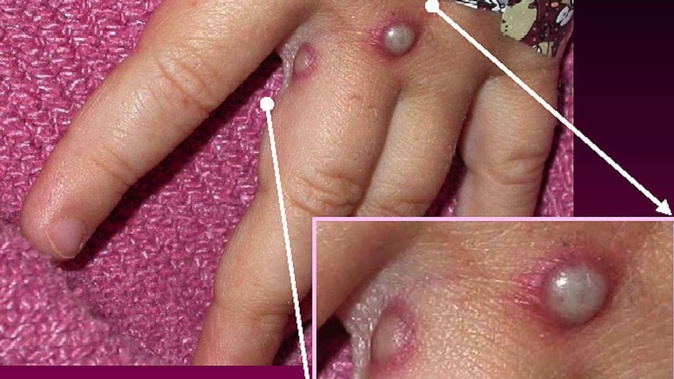 At least 13 countries have reported Mpox infections. Photo / File